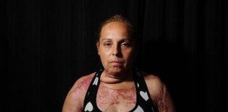 Tentativa de femicidio: 11 años por quemar a su pareja